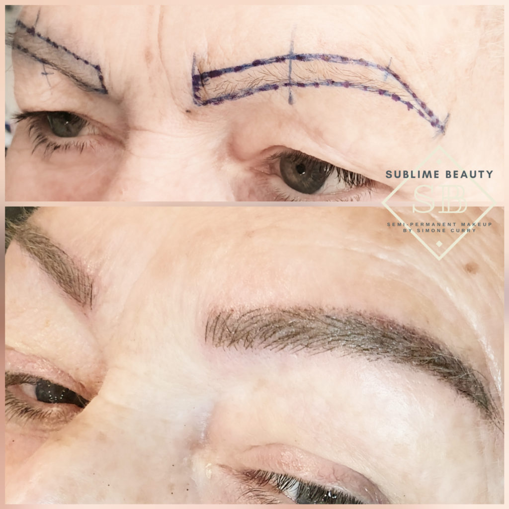 Combination eyebrow treatment with face mapping and end results